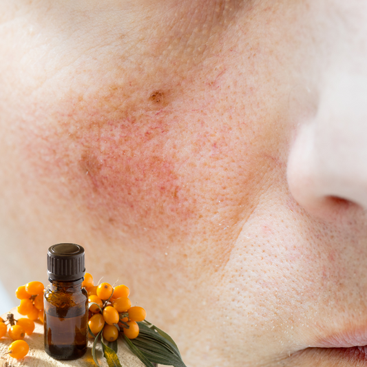 How Sea Buckthorn Oil Naturally Heals Wounds